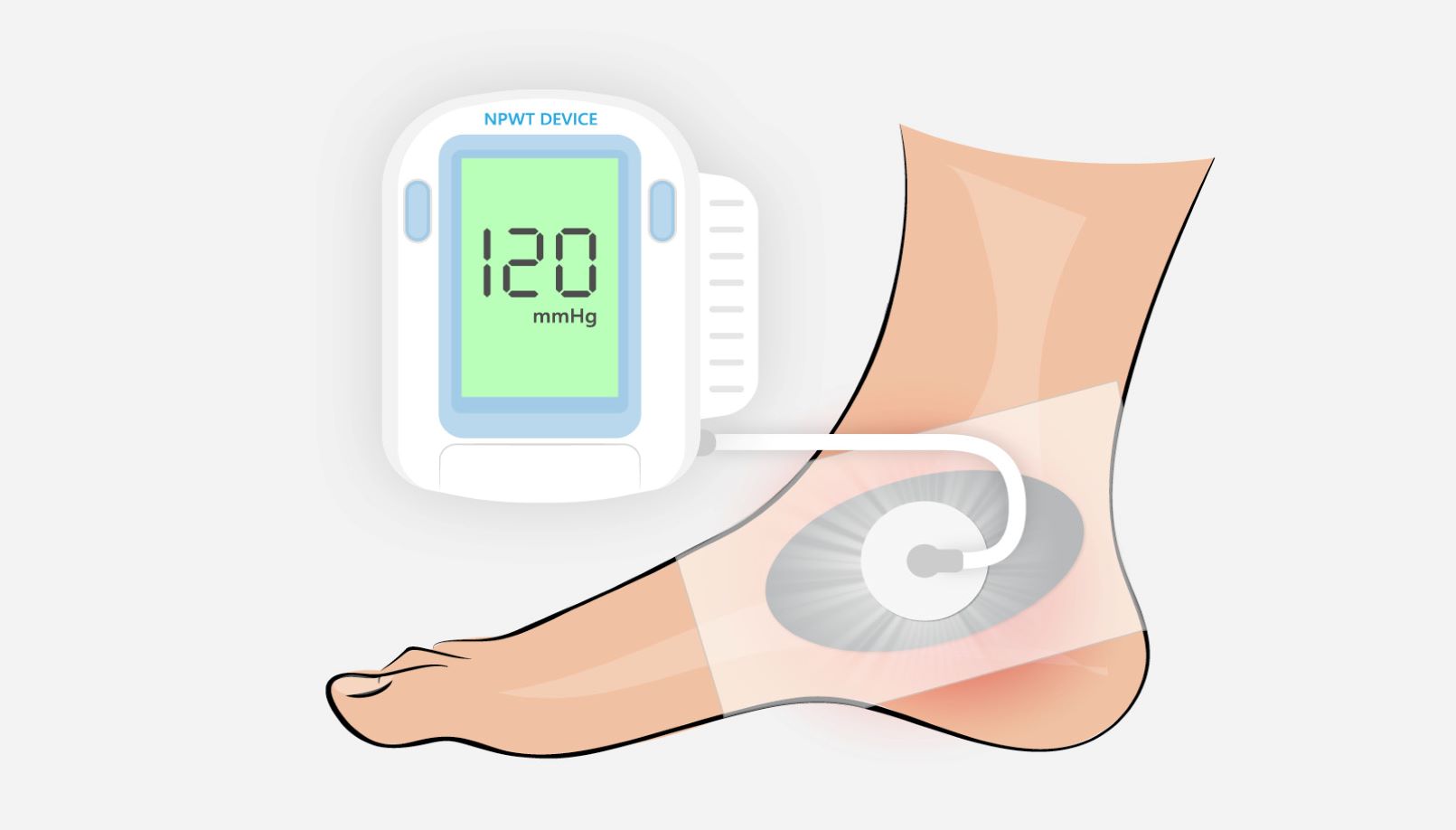 scapa npwt blog social v2 blog